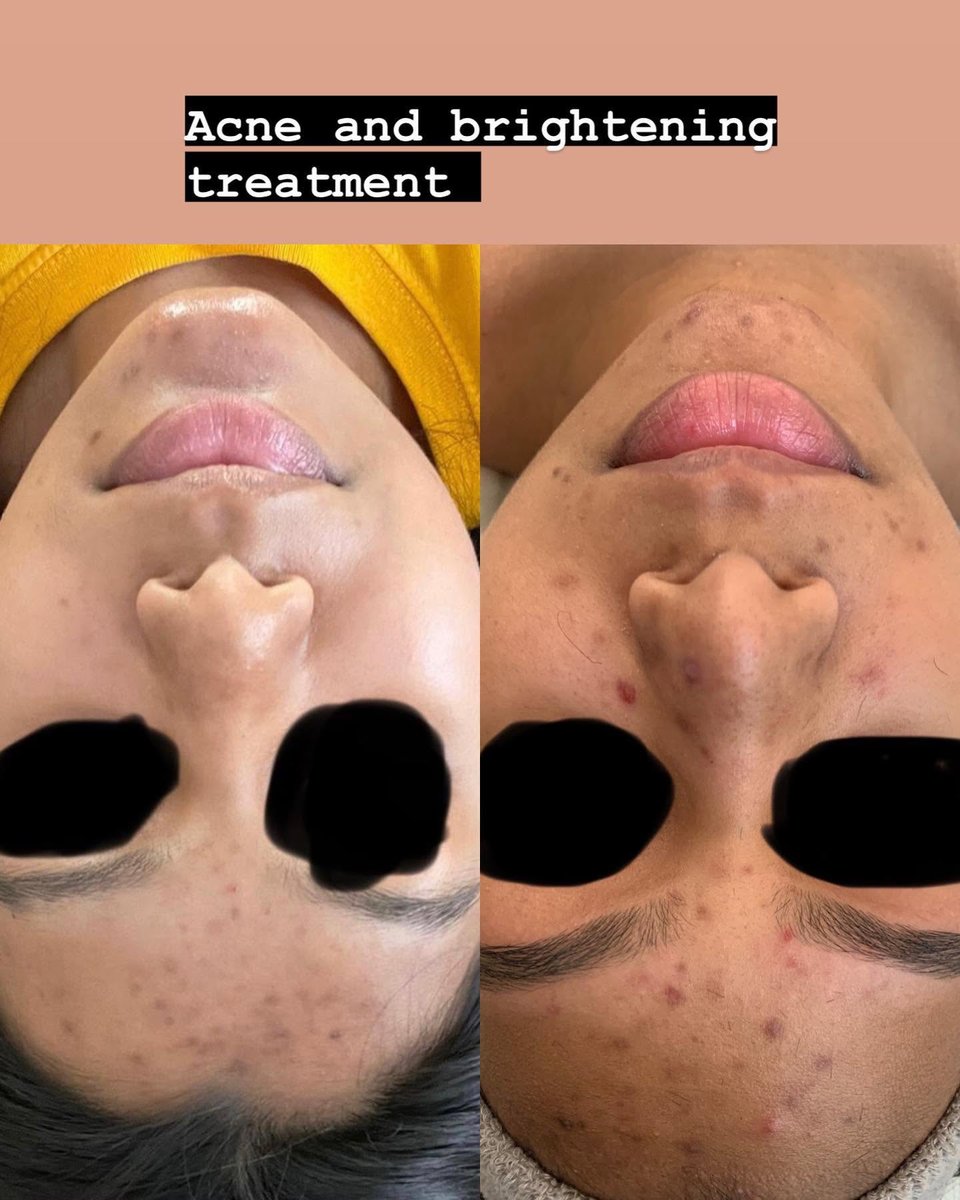 Acne and brightening facial treatment before and after