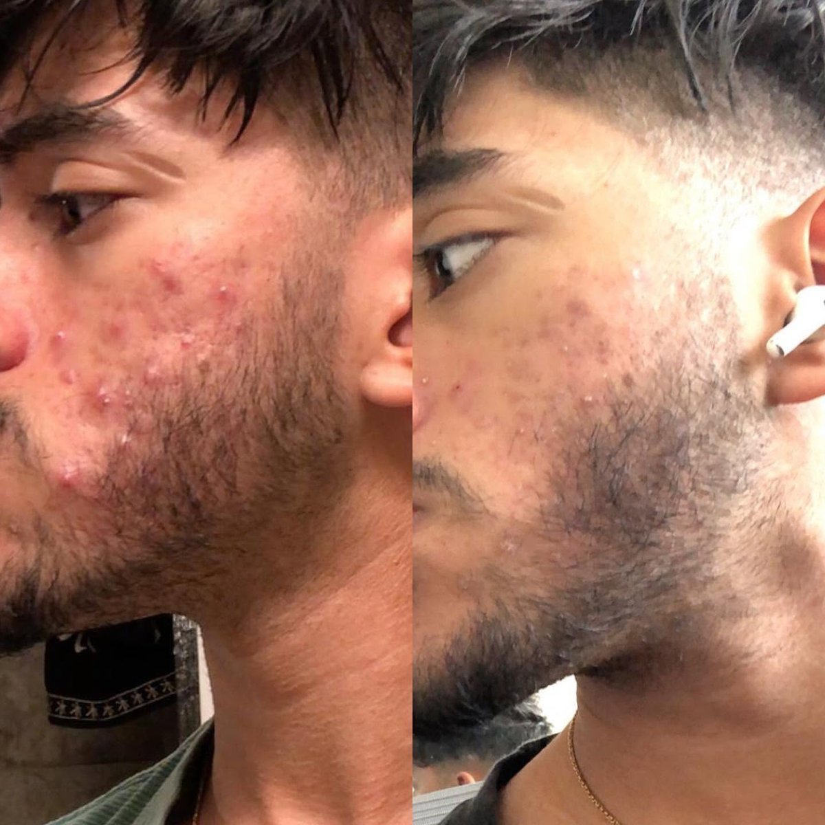 Acne facial treatment before and after, male client