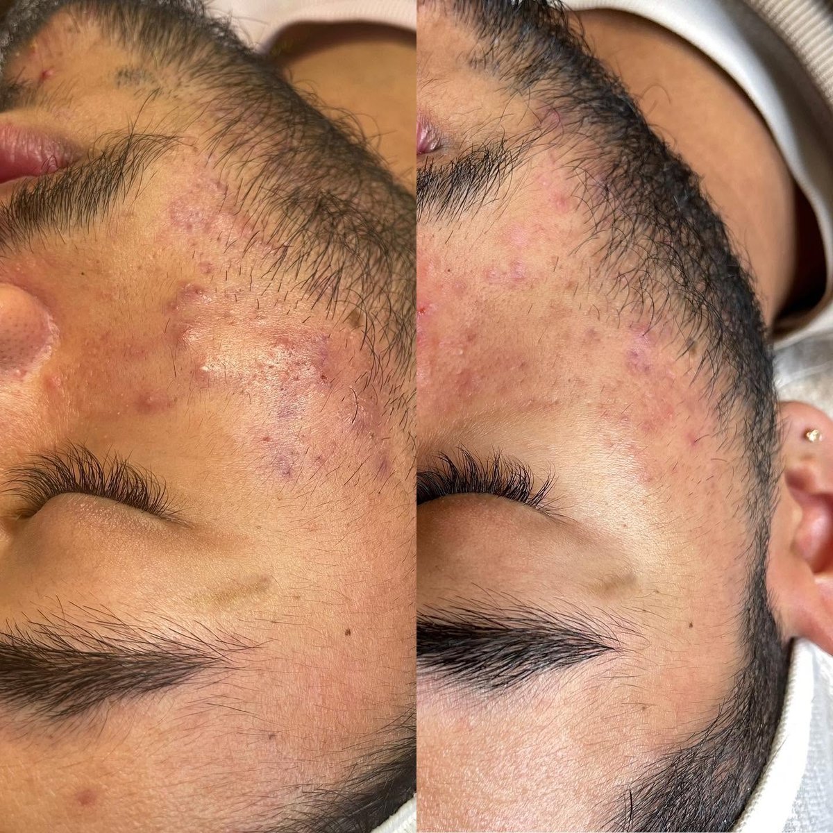 Acne treatment progress, close-up before and after